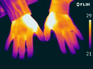 Women with cold hands in infrared thermography