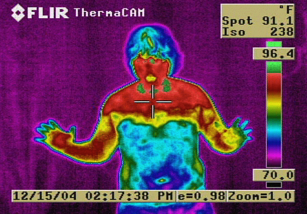 Thermographie d'un patient souffrant du syndrome du corps dissocié deux ans après une sympathectomie