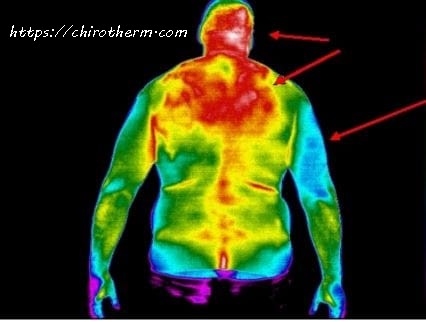 C5 subluxation affecting the rhomboids in medical thermography