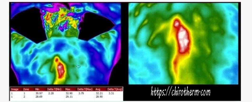 Melanoma see in thermography