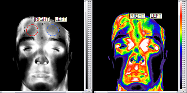 La thermographie ci-présentée est destinée à étudier la symétrie thermique ou non du visage humain durant des stimuli
