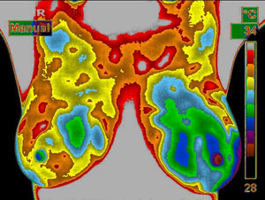 Cancer Thermography of a breast'cancer