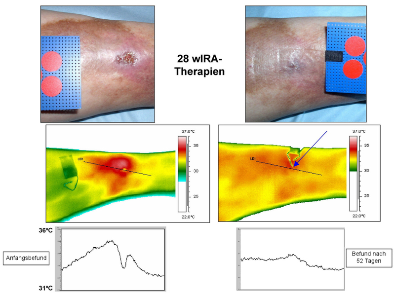 Follow up of medical treatment thanks to thermography