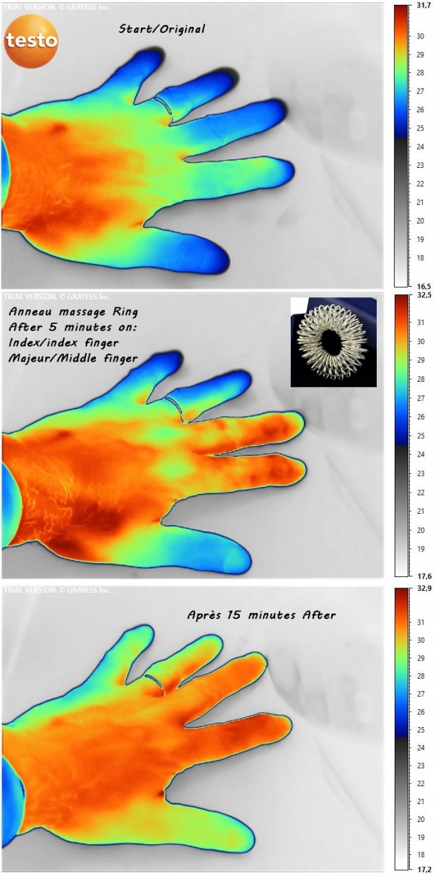 "massage ring in thermography