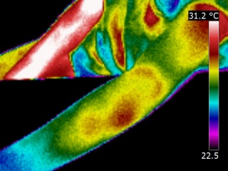 Thermographie du bras d'une personne souffrant d'une contusion intramusculaire