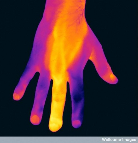 main avec un doigt infecté vue en thermographie infrarouge, http://wellcomeimages.org/indexplus/page/Prices.html Copyrighted work available under Creative Commons by-nc-nd 4.0 by Wellcome