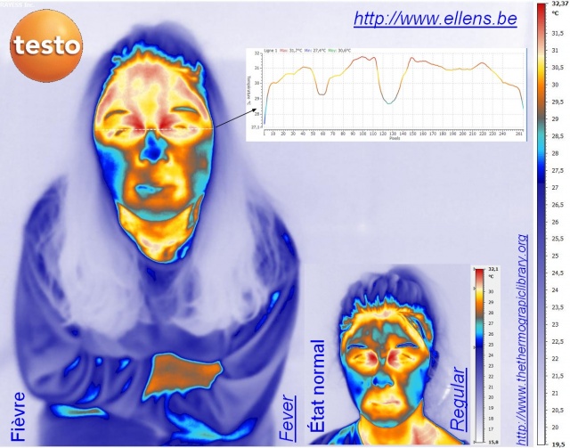 Infrared medical thermography of a young girl with and without fever