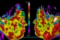 Dental-pain-thermography.jpg