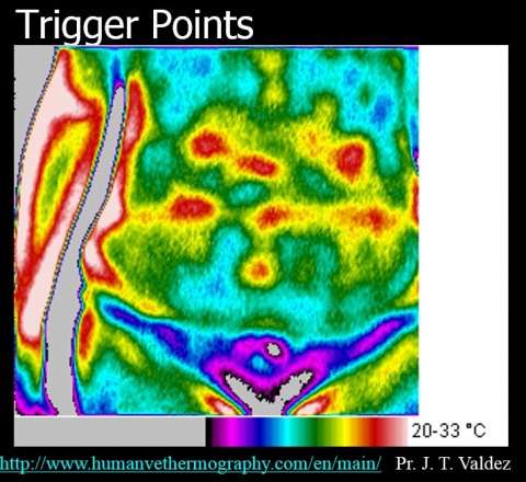Thermographic view of trigger points sight