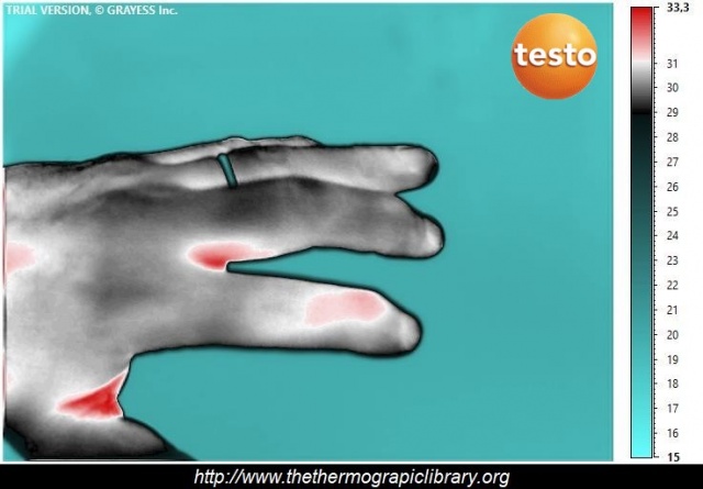Thermographie médicale infrarouge d'une tendinite du doigt, index