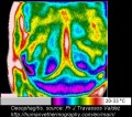 Esophagitis-thermography.jpg