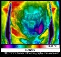 Colitis-medical-thermography.JPG