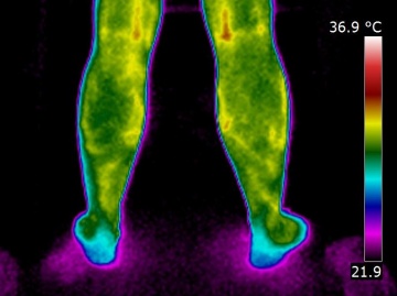 Thermal infrared imagery of varicosity
