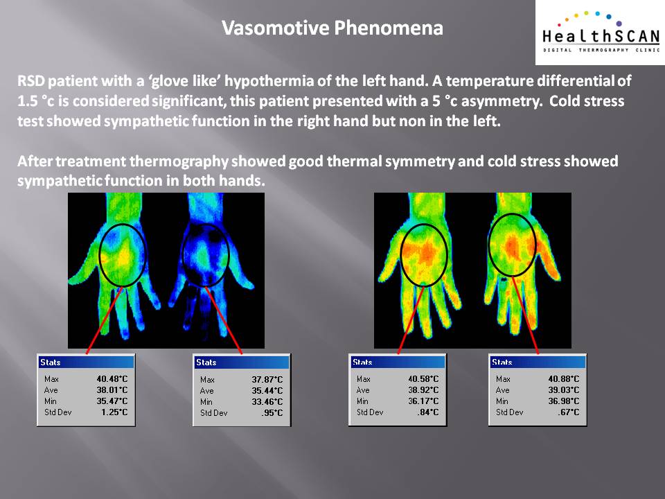 Circulation-Thermography-Changes.jpg
