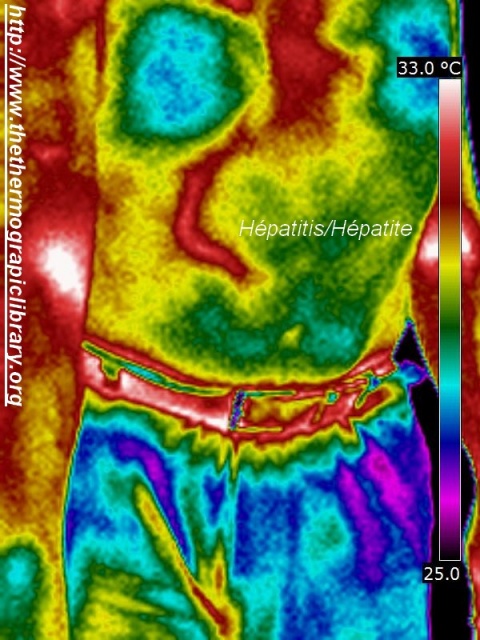 Thermography of a light reversible hepatitis seen in thermography