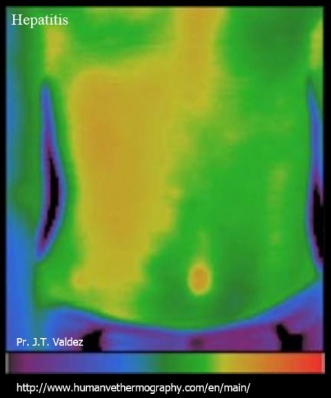 Hepatitis in human body, medical thermography