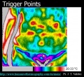 Trigger-points-thermography-valdez.jpg