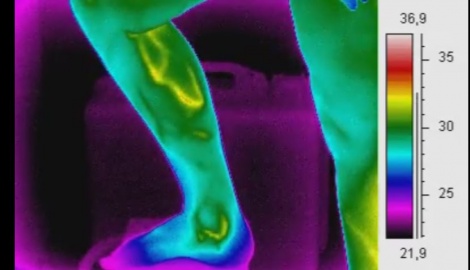 Thermographie d'un mollet atteint de varices