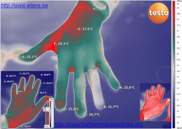 Thermographie médicale d'un problème circulatoire dans une main et plus spécifiquement à l'annulaire